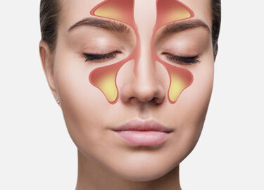 Balloon Sinuplasty