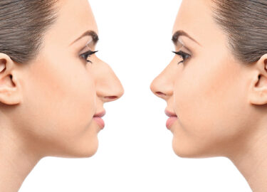 Can a 17-Year-Old Get a Rhinoplasty?