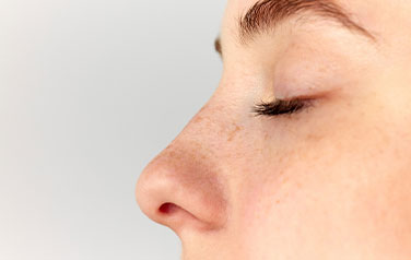 Nasal Turbinate Hypertrophy - Concha Hypertrophy