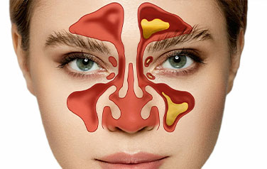 Sinusitis Surgery and Treatment