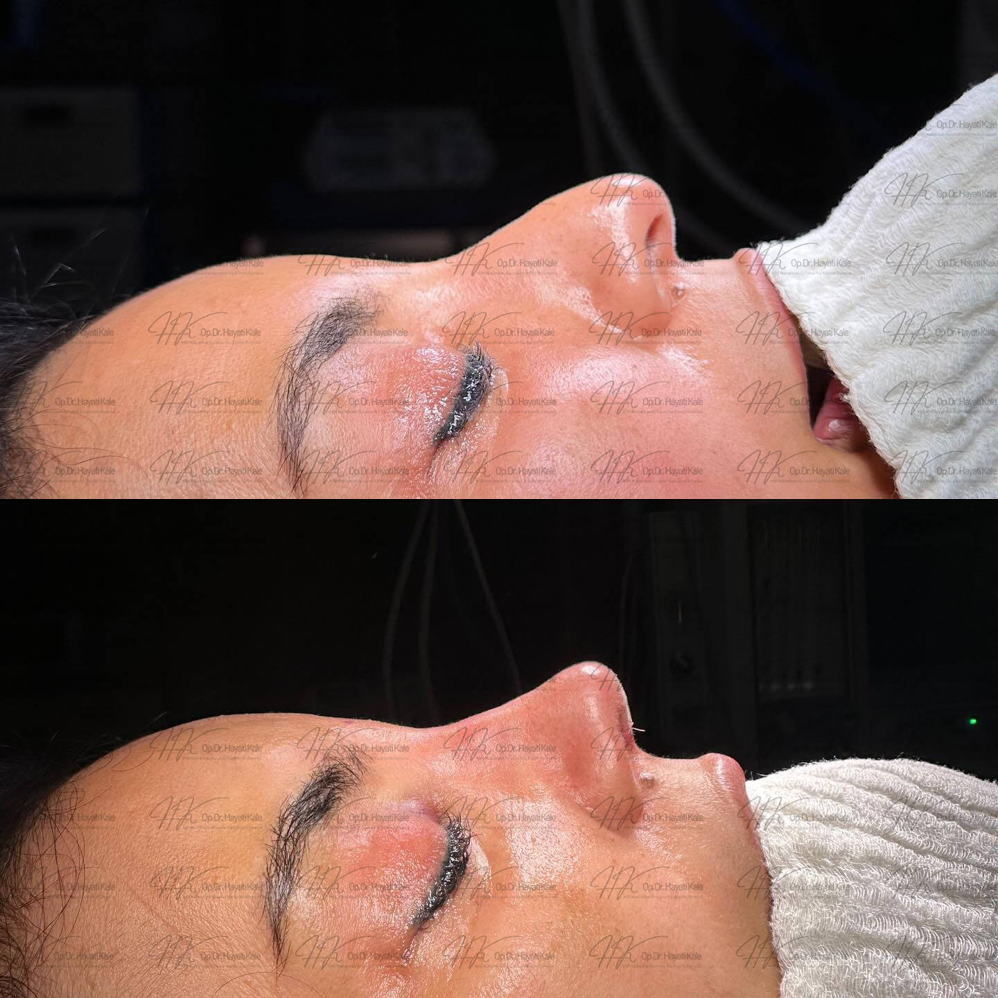 before-after