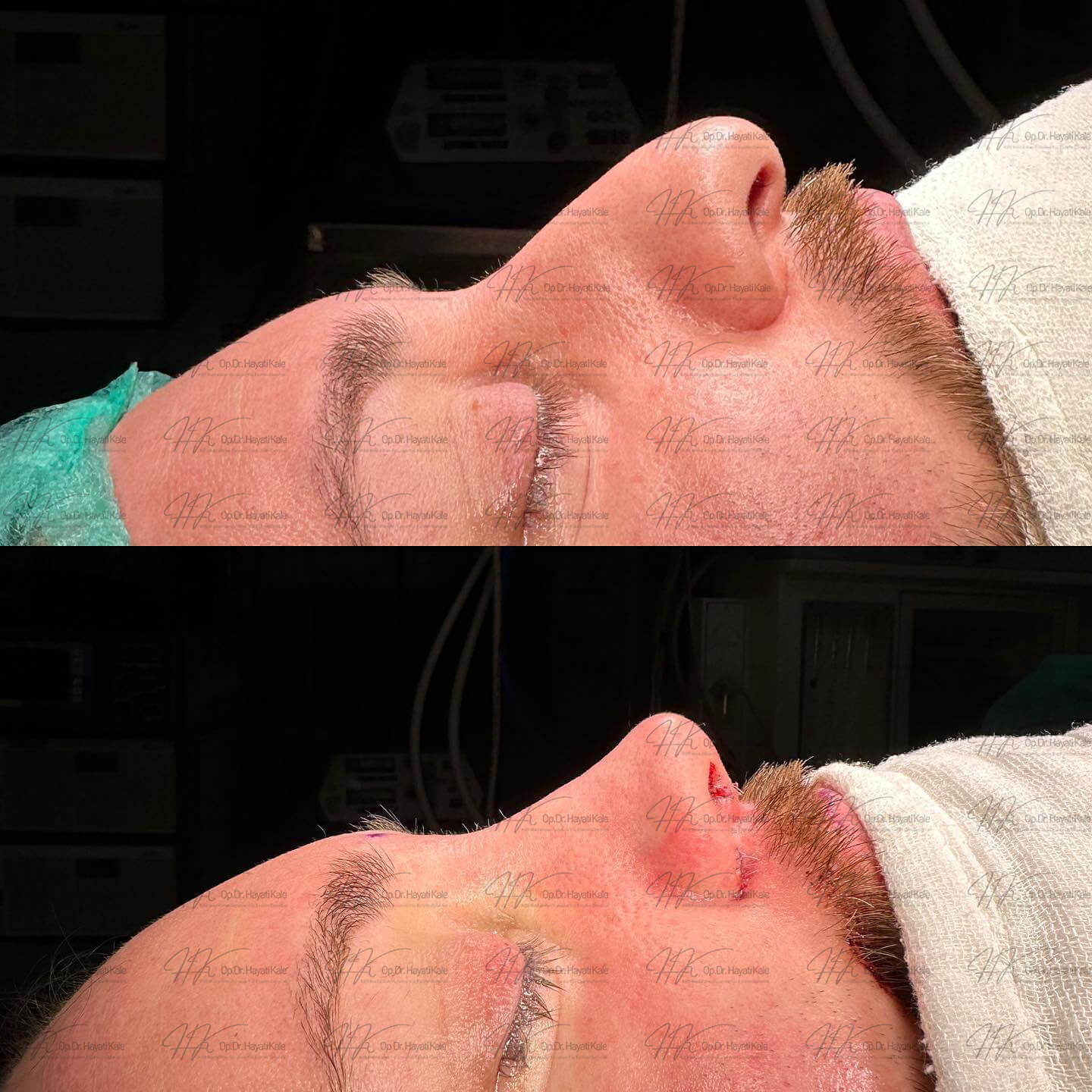 before-after