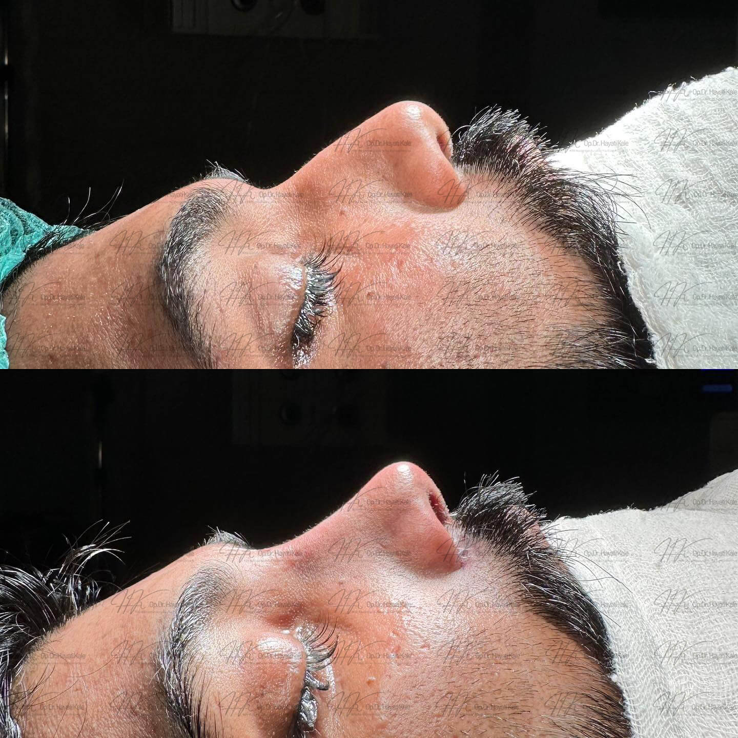 before-after
