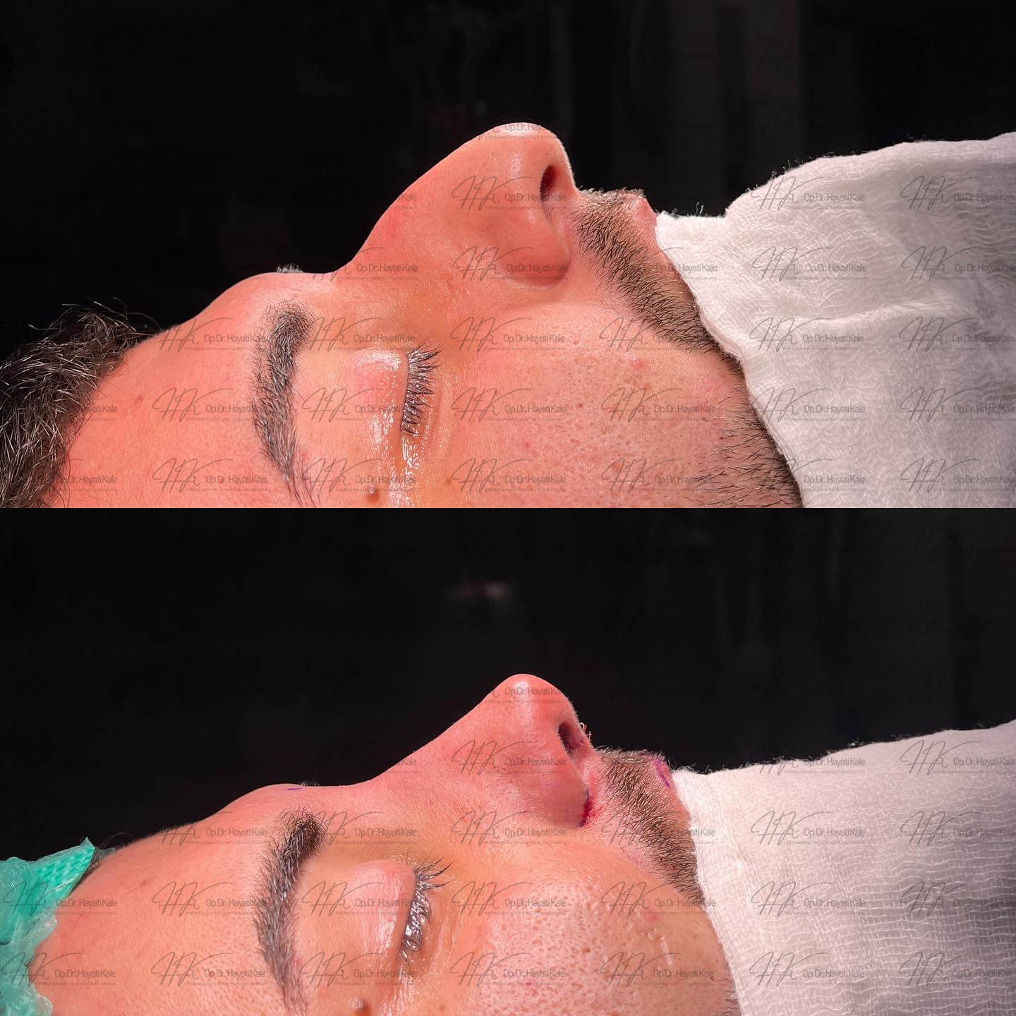 before-after