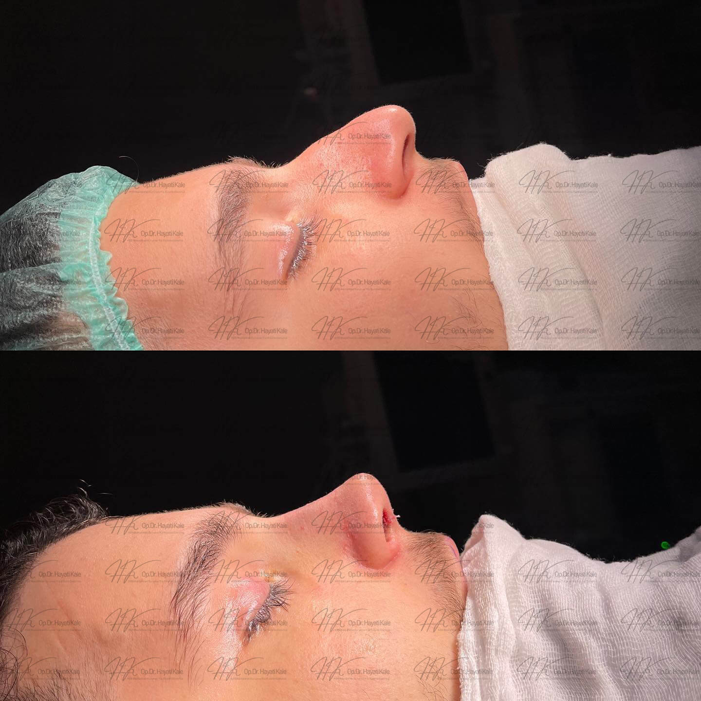 before-after