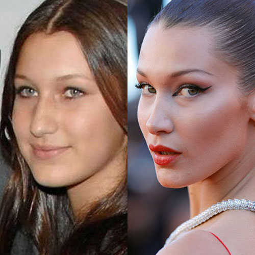 Poznate Ličnosti Koje Su Imale Rinoplastiku 19 bella hadid burun estetigi