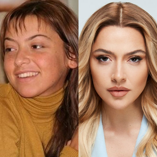 Poznate Ličnosti Koje Su Imale Rinoplastiku 3 hadise burun estetigi