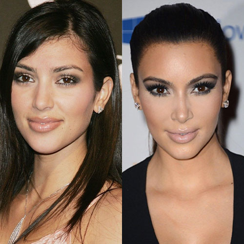 Poznate Ličnosti Koje Su Imale Rinoplastiku 12 kim kardashian burun estetigi