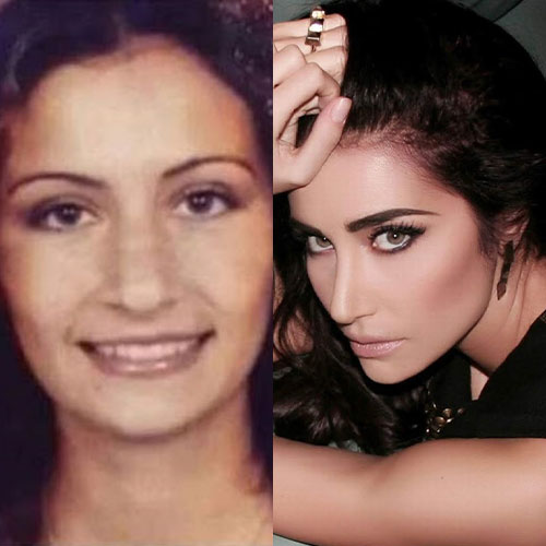 Poznate Ličnosti Koje Su Imale Rinoplastiku 7 sila gencoglu burun estetigi