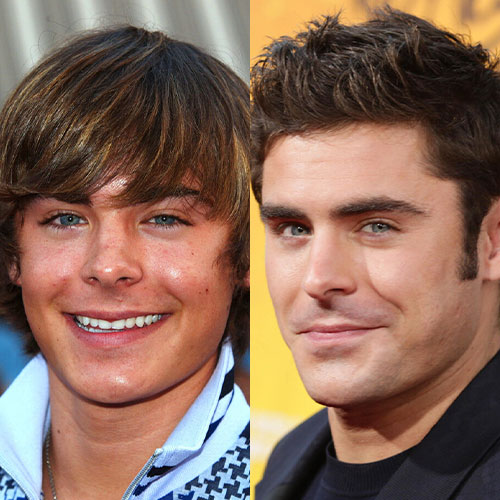 Poznate Ličnosti Koje Su Imale Rinoplastiku 18 zac efron burun estetigi