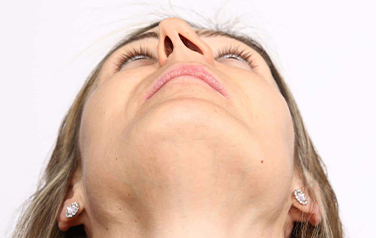 Operacija devijacije septuma - Septoplastika