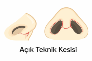Burun Estetiği 1 Açık Teknik Kesisi