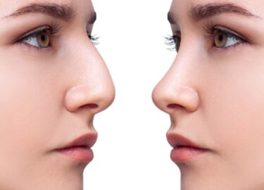 Yamuk Burun Kemiği Nasıl Düzeltilir?